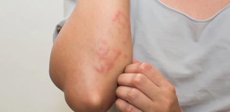 Glutenallergy-130424