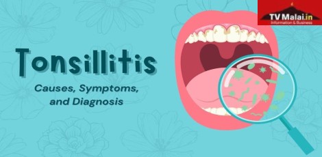 Tonsillitis – Various important things to know!!