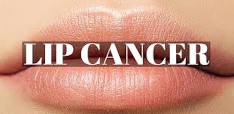 What is lip cancer? – Various reasons for lip cancer and treatments etc!!