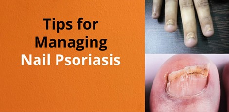 Nail psoriasis condition, its signs and treatments etc – Important things to know!!