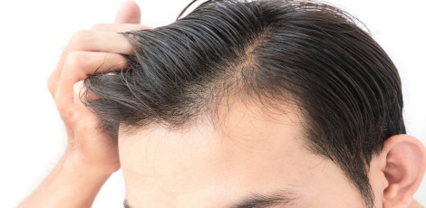 hair-loss-280125