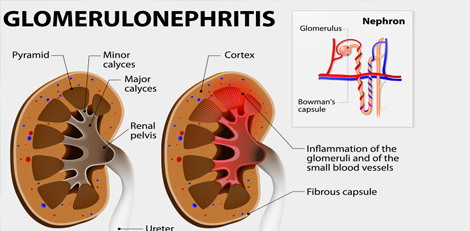 What is glomerulonephritis – Its causes, symptoms, treatment etc!!
