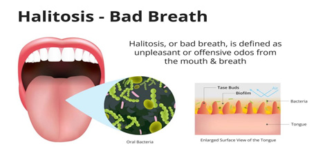 Having Halitosis or Bad breath problem? – These can be the important reasons!!
