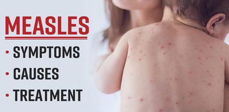 Be careful!! Know about these scary health issues that can affect you after you get measles!!