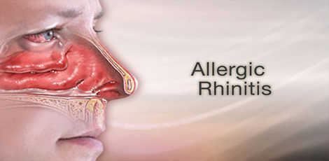 How pollution is making the allergic rhinitis problem in us to turn worse?