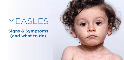 Be careful!! Know about these scary health issues that can affect you after you get measles!!