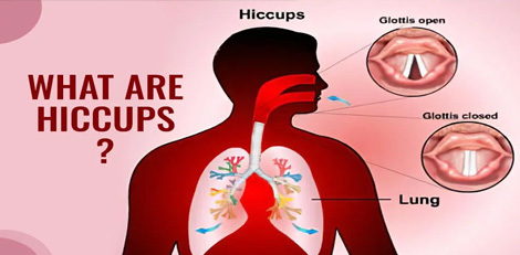 Getting hiccups or Vikkal – Their causes, remedies etc!!