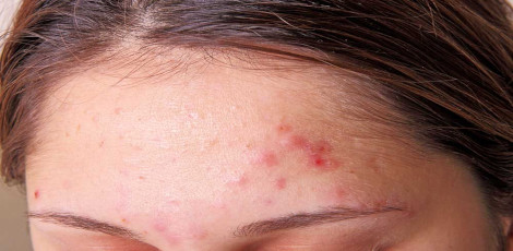 Pimples on various parts of our body – Important things to know!!