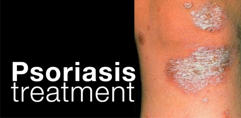 These essential oils can help us to manage psoriasis issue effectively!!