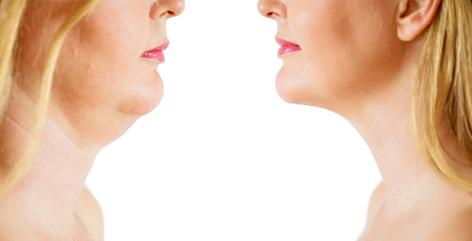 How to Reduce Face Fat Naturally