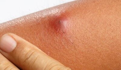 Boils: Causes, Symptoms, and Treatment