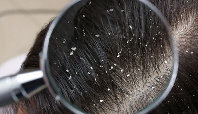 Home Remedies to Get Rid of Dandruff Naturally