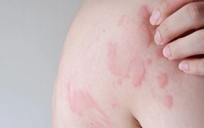 Hives (Urticaria) Alert: Causes, Symptoms & Prevention Tips You Should Know