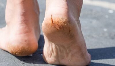 Effective Home Remedies to Treat Cracked Heels