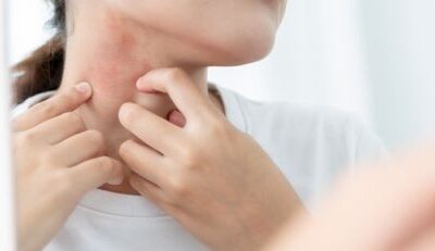 Heat Rash: What Is It and How to Get Quick Relief?