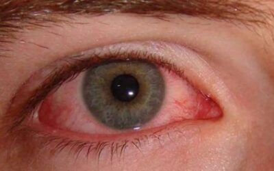 Madras Eye Prevention in Summer: Symptoms, Causes, and Safety Recommendations