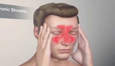 Sinusitis Symptoms, Causes & Treatment: Complete Guide