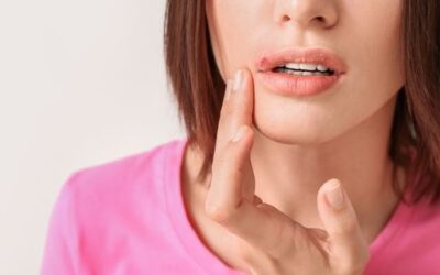 Cold Sores: Symptoms, Causes, Treatment & Prevention