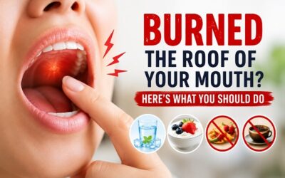 Burned the Roof of Your Mouth? Here’s What You Should Do